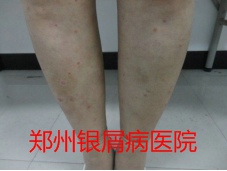 郑州牛皮癣医院治疗牛皮癣图片