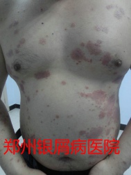 郑州牛皮癣医院治疗牛皮癣图片