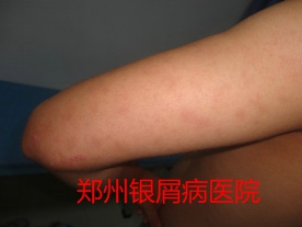 郑州牛皮癣医院治疗牛皮癣图片