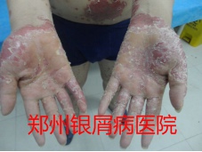 郑州牛皮癣医院治疗牛皮癣图片
