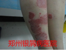 郑州牛皮癣医院治疗牛皮癣图片