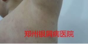 郑州牛皮癣医院治疗牛皮癣图片