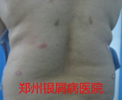 郑州牛皮癣医院治疗牛皮癣图片