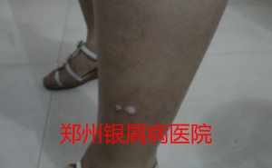 郑州牛皮癣医院治疗牛皮癣图片